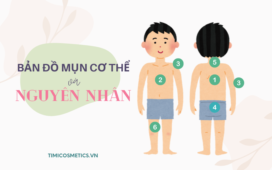 BẢN ĐỒ MỤN TRÊN TOÀN CƠ THỂ VÀ NGUYÊN NHÂN GÂY RA CHÚNG