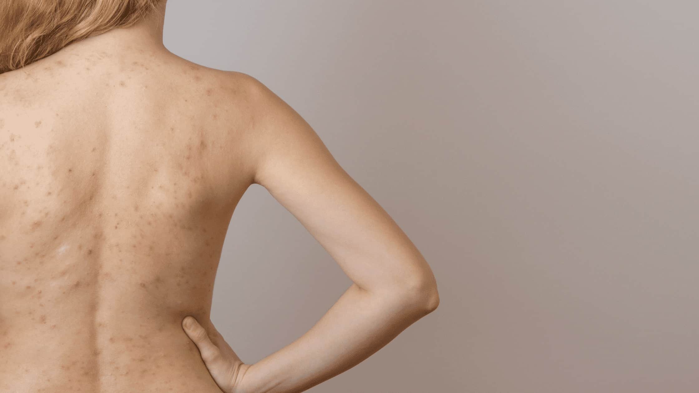 CƠ CHẾ HÌNH THÀNH MỤN CƠ THỂ 🌿🔍