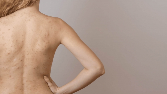 CƠ CHẾ HÌNH THÀNH MỤN CƠ THỂ 🌿🔍