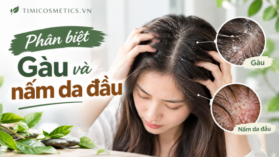 Phân biệt gàu và nấm da đầu: Dấu hiệu nhận biết & cách chăm sóc